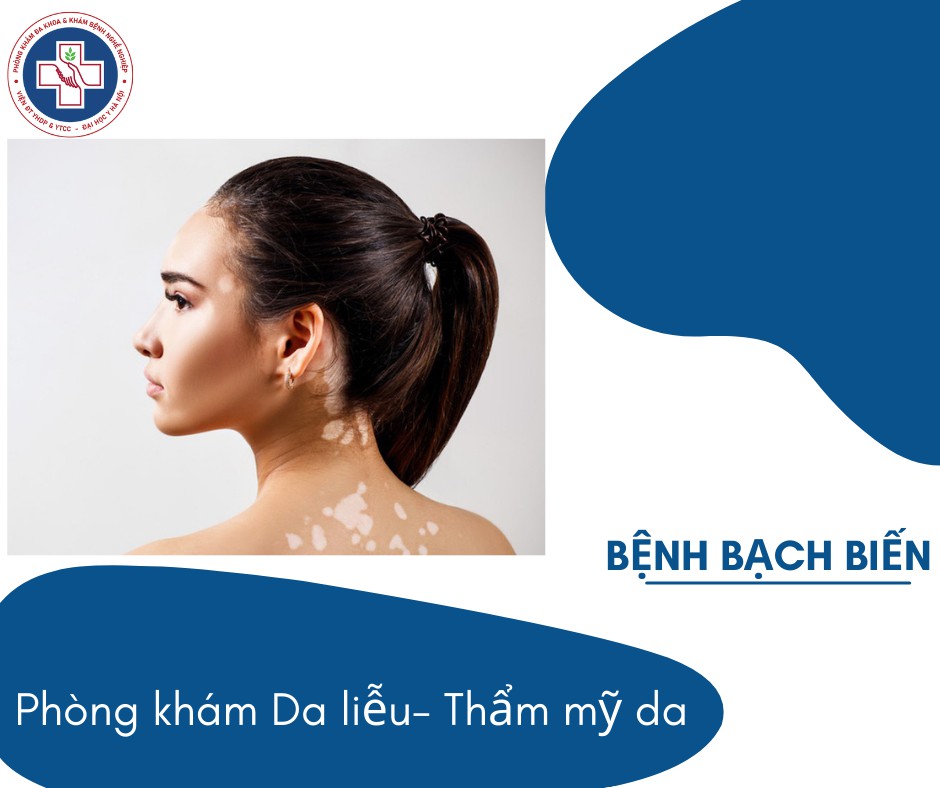 NHỮNG ĐIỀU CẦN BIẾT VỀ BỆNH BẠCH BIẾN