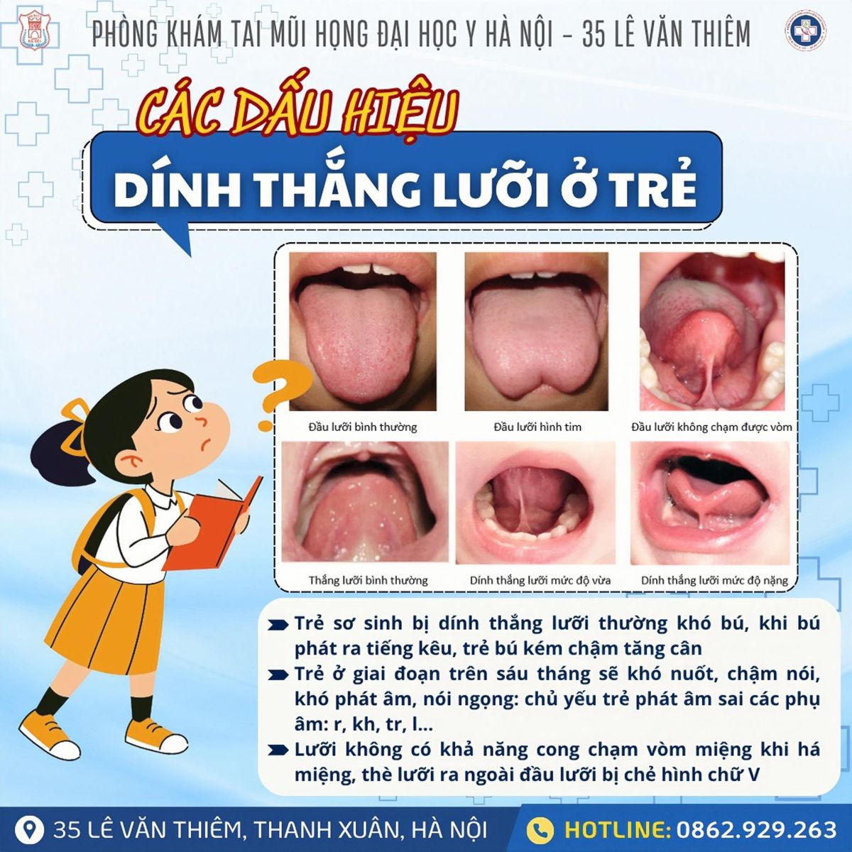 CÁC DẤU HIỆU DÍNH THẮNG LƯỠI Ở TRẺ!