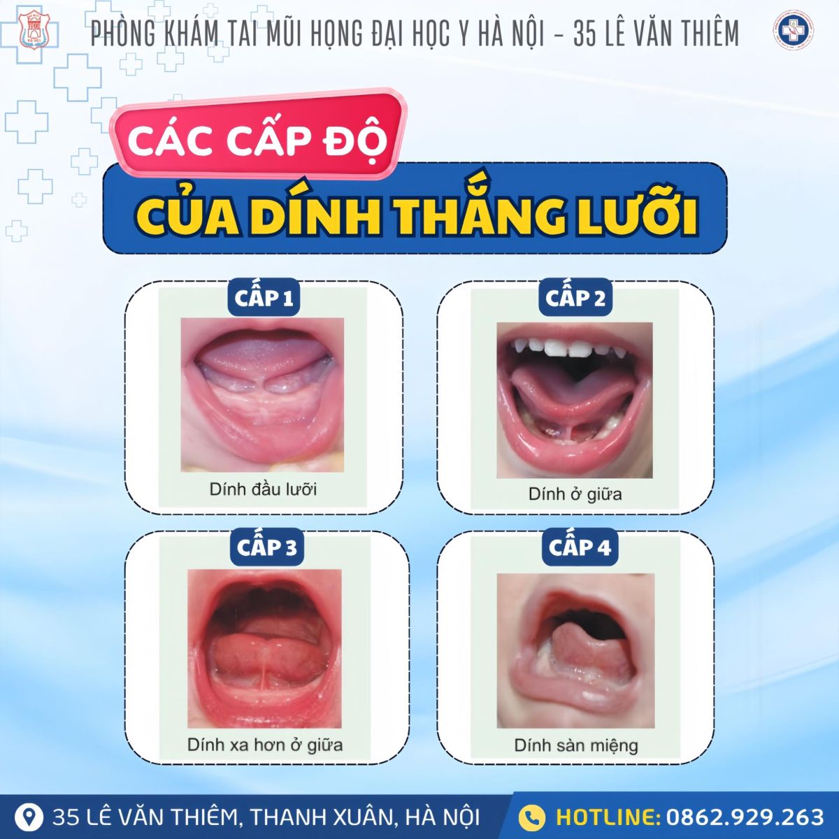 CÁC CẤP ĐỘ CỦA DÍNH THẮNG LƯỠI – BA MẸ CẦN BIẾT!