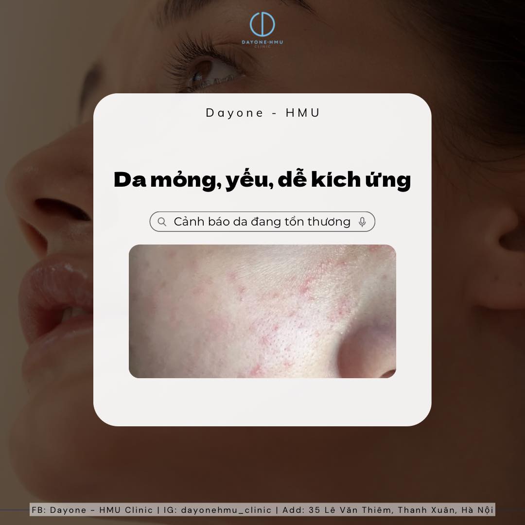 Da mỏng, yếu, dễ kích ứng - Tín hiệu cầu cứu từ làn da bạn!