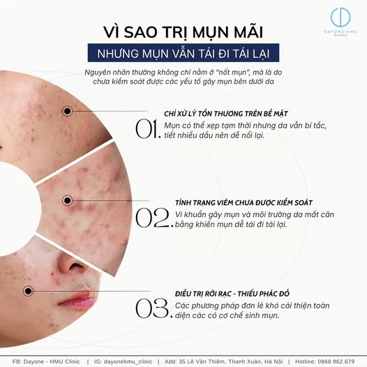 VÌ SAO TRỊ MỤN MÃI DA KHÔNG CÓ KẾT QUẢ?