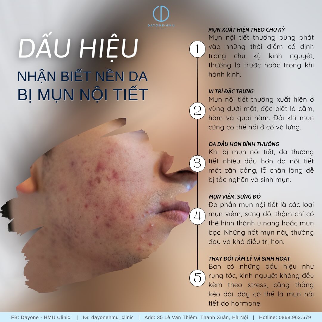 DẤU HIỆU NHẬN BIẾT MỤN NỘI TIẾT – BẠN CÓ ĐANG GẶP?