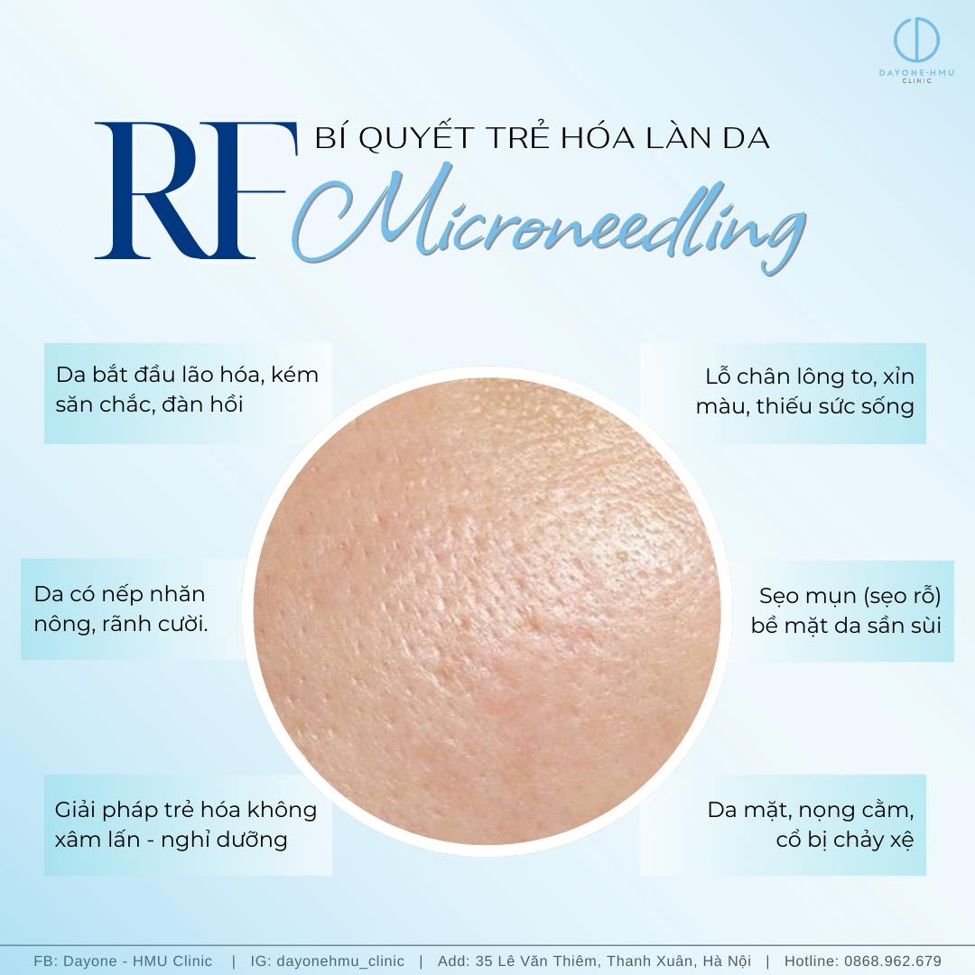 RF MICRONEEDLING | FEEDBACK TỪ KHÁCH HÀNG
