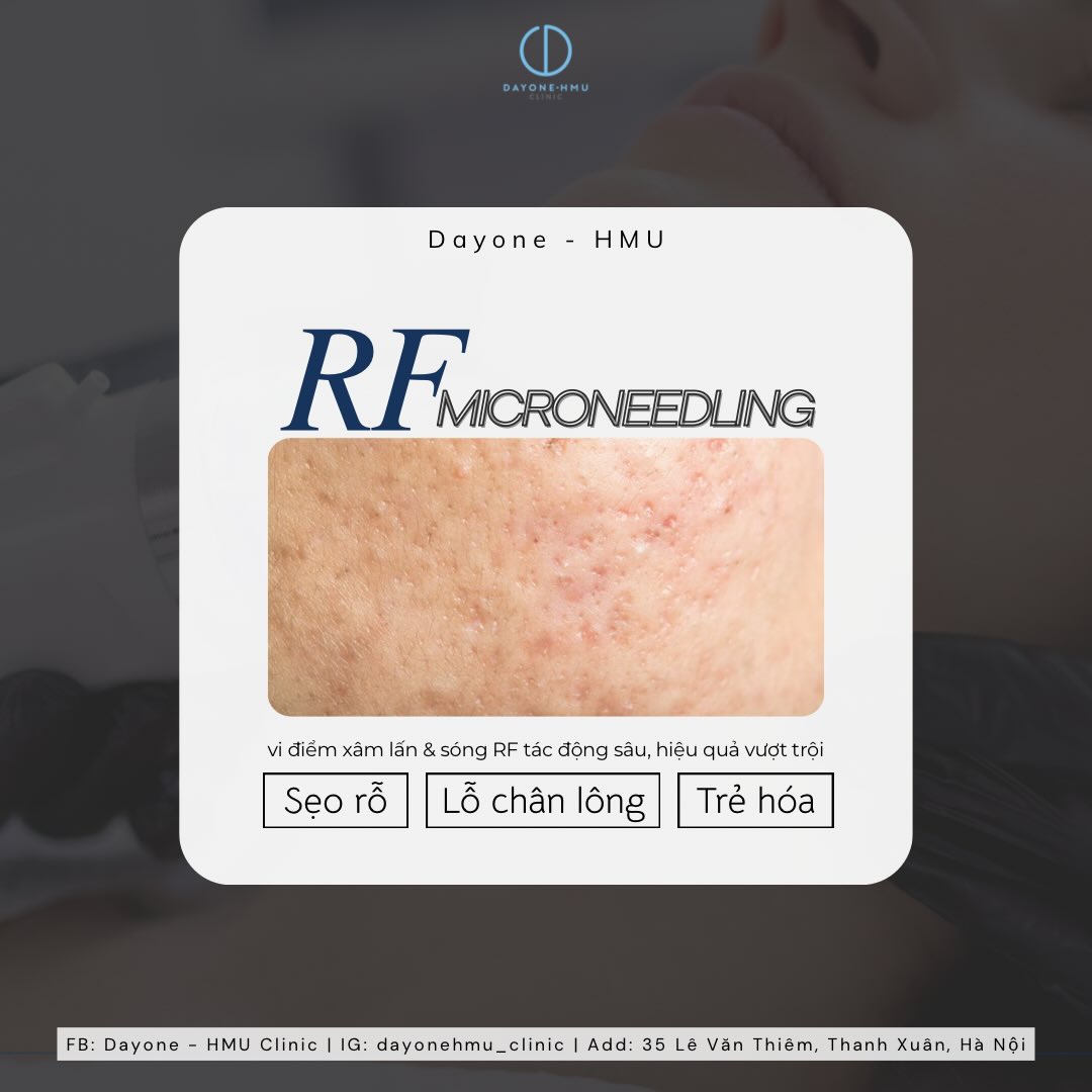 RF Microneedling - CÔNG NGHỆ TRẺ HÓA & TÁI TẠO DA TỐI ƯU