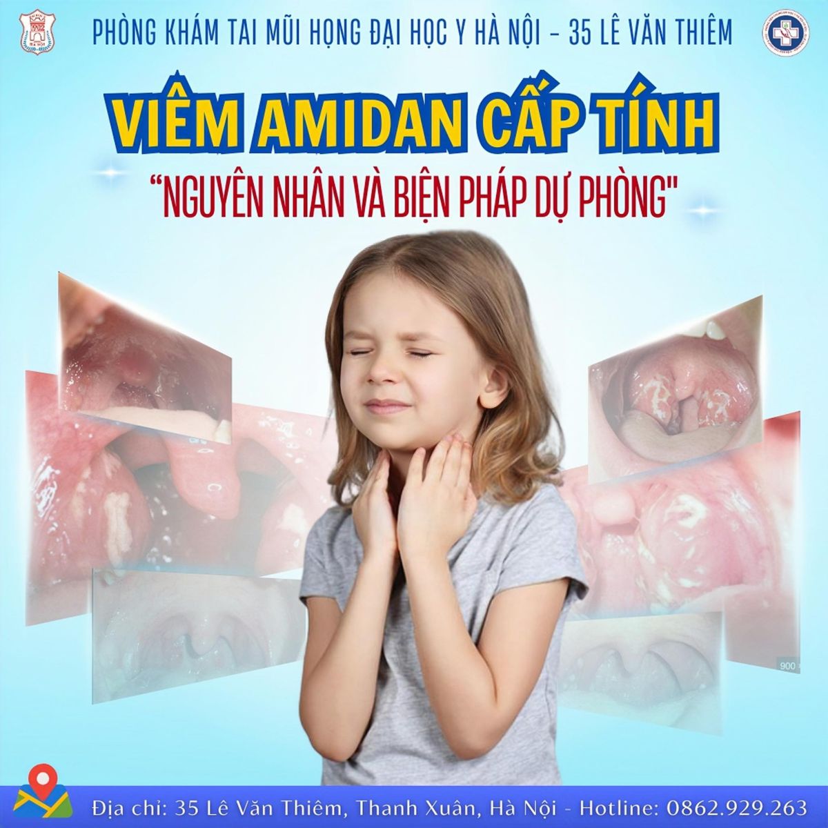 VIÊM AMIDAN CẤP TÍNH: NGUYÊN NHÂN VÀ BIỆN PHÁP DỰ PHÒNG