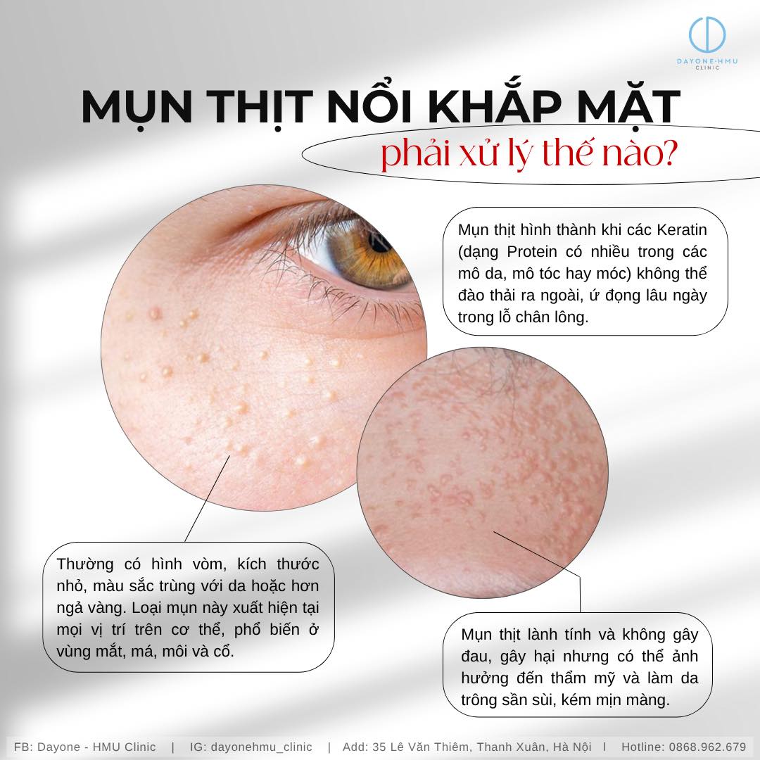 CÔNG NGHỆ ĐIỀU TRỊ MỤN THỊT TẠI PHÒNG KHÁM DA LIỄU ĐAHỊ HỌC Y HÀ NỘI