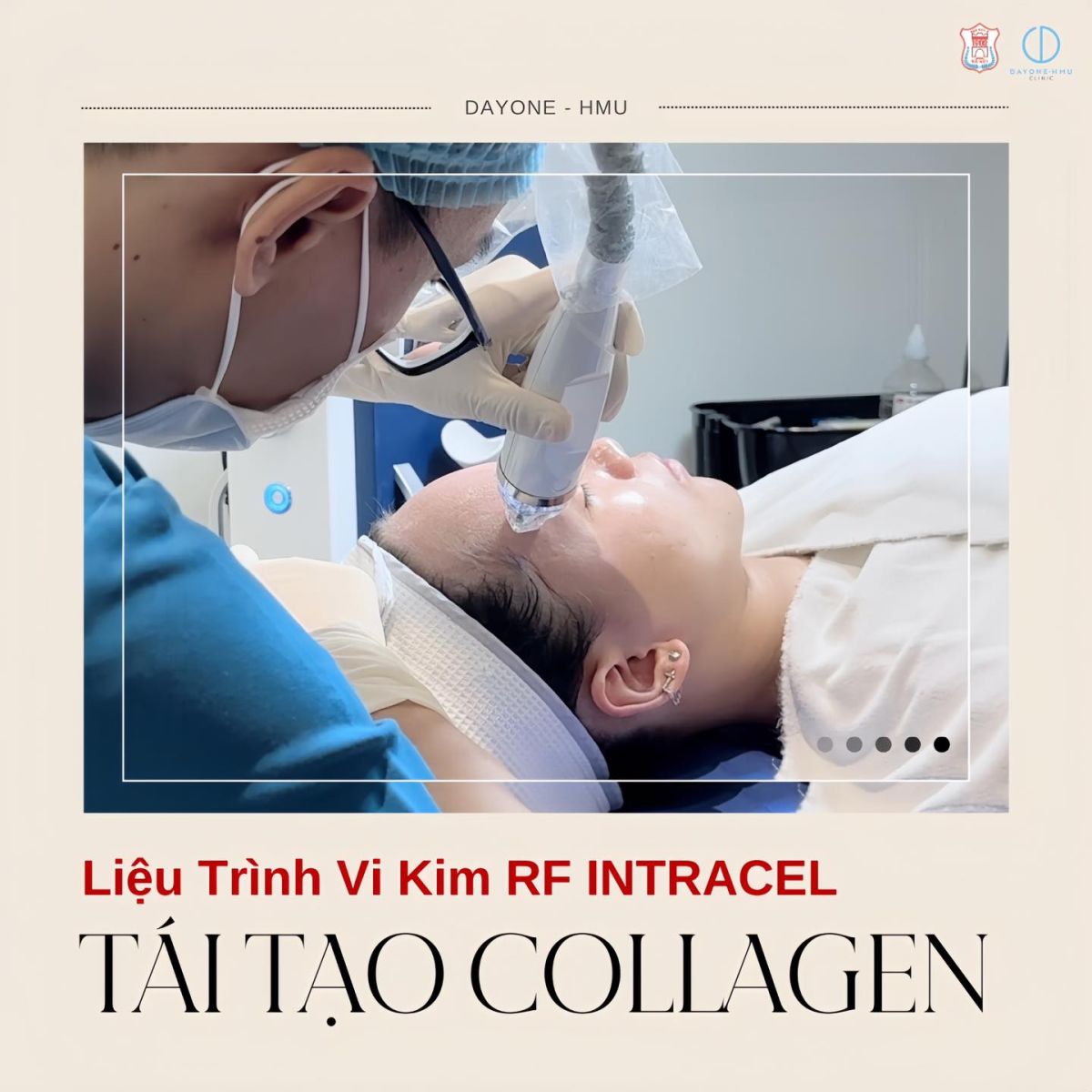 LIỆU TRÌNH VI KIM RF INTRACLE - TÁI TẠO COLLAGEN